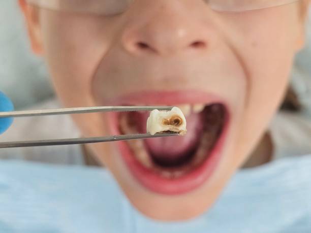 Best Root Canal Emergency Dentist  in Laguna Park, TX